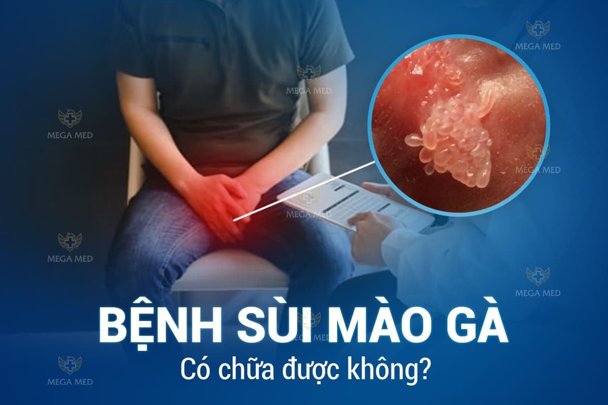 Sùi mào gà có chữa được không